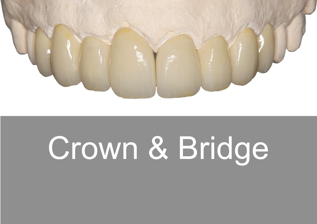 Crown & Bridge - Bremadent Dental Laboratory, London