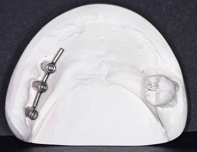 Swissedent removable implant denture on screw retained CM bar.
