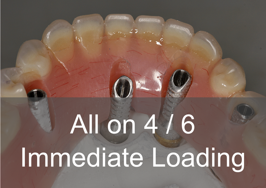 All on 4/6 Immediate implant loading 