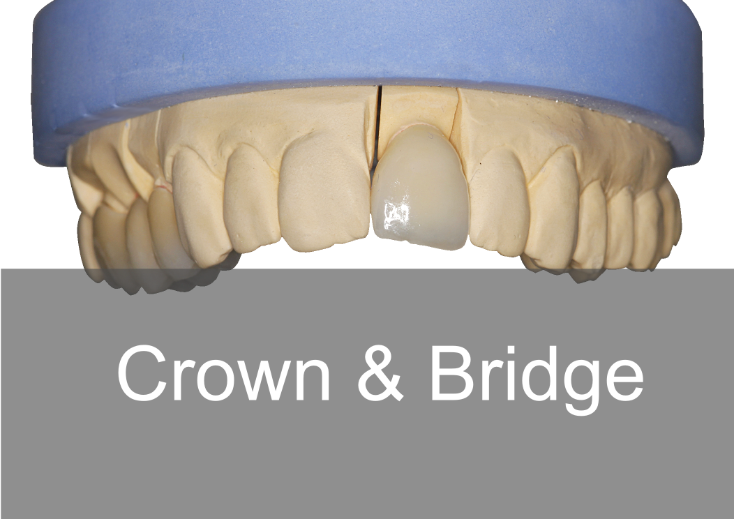 Crown & Bridge - BPL Dental Laboratory London