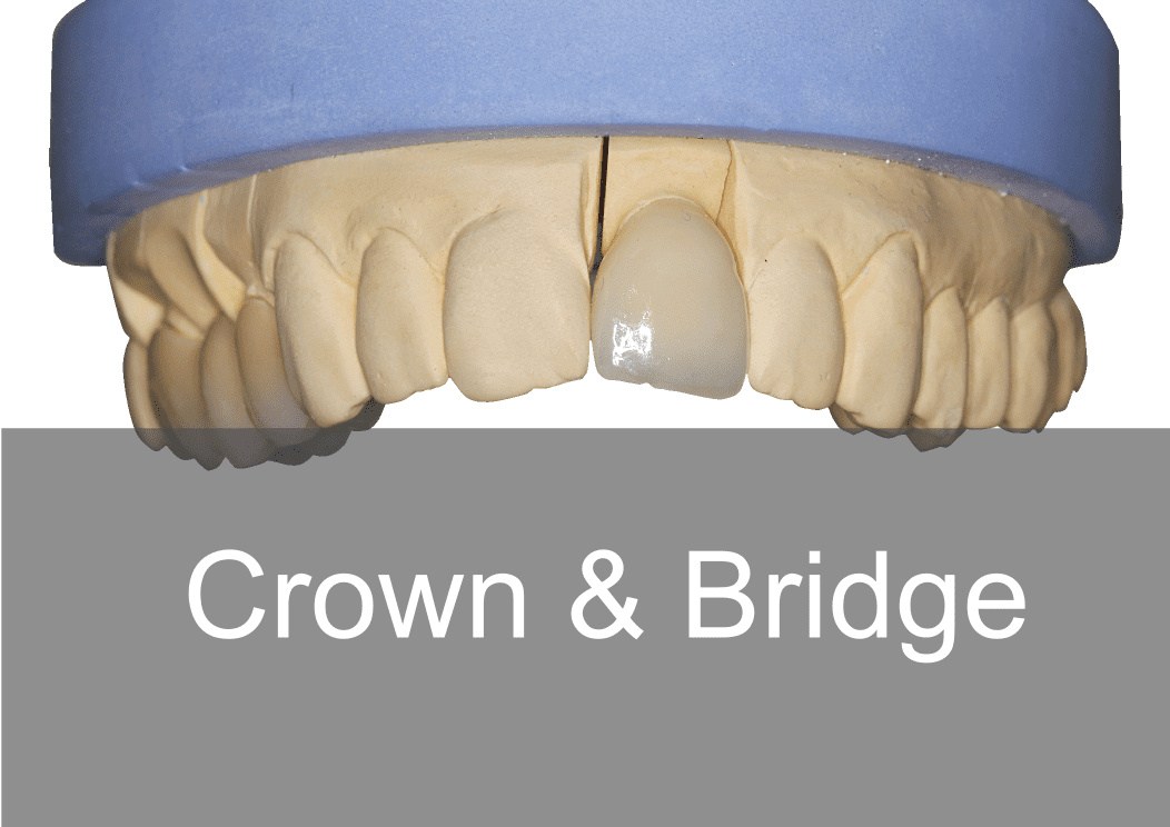 Crown & Bridge - Bremadent Dental Laboratory 