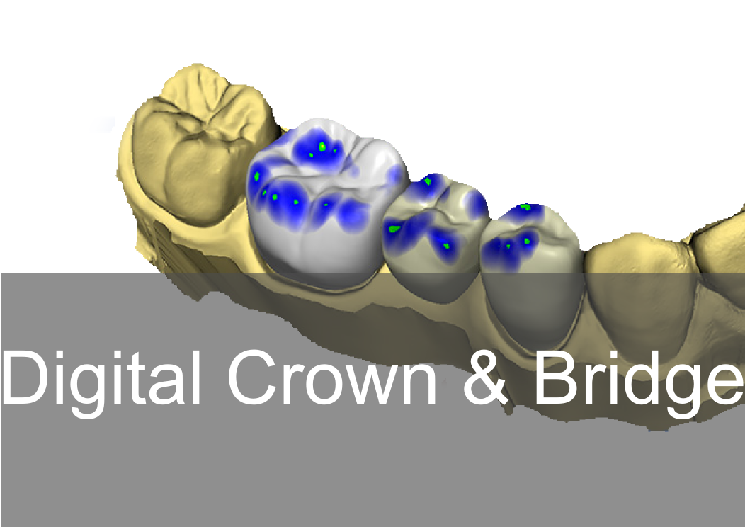 Digital Crown & Bridge - Bremadent Dental Laboratory in London 