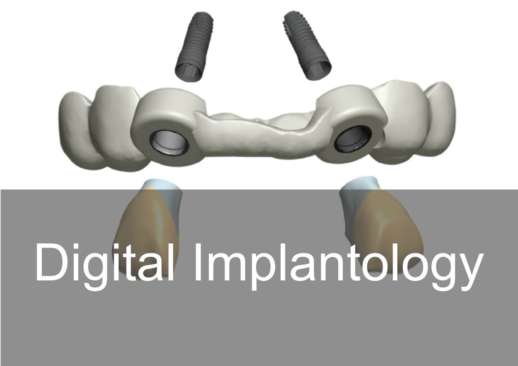 Digital Implantology - Bremadent Dental Laboratory in London