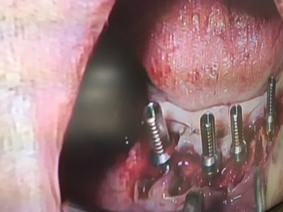 Immediate Implant Loading at Bremadent Dental Laboratory in London UK.