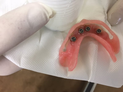 Immediate Implant Loading at Bremadent Dental Laboratory in London UK.