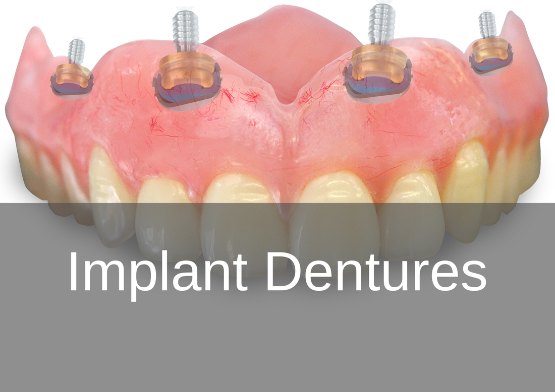 Implant Dentures - Bremadent Dental Laboratory, London