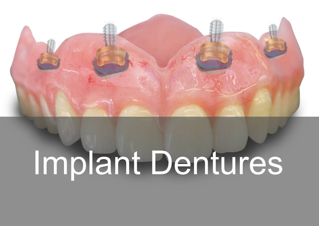 Implant Dentures - Bremadent Dental Laboratory 