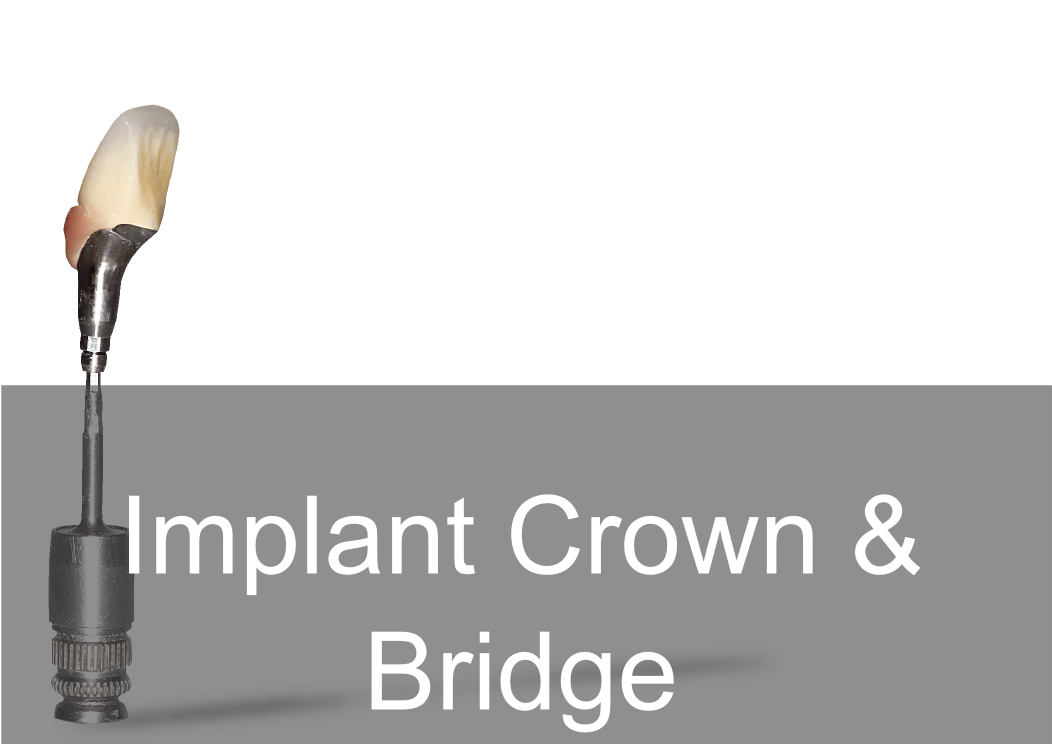Implant Crown & Bridge - Bremadent Dental Laboratory 