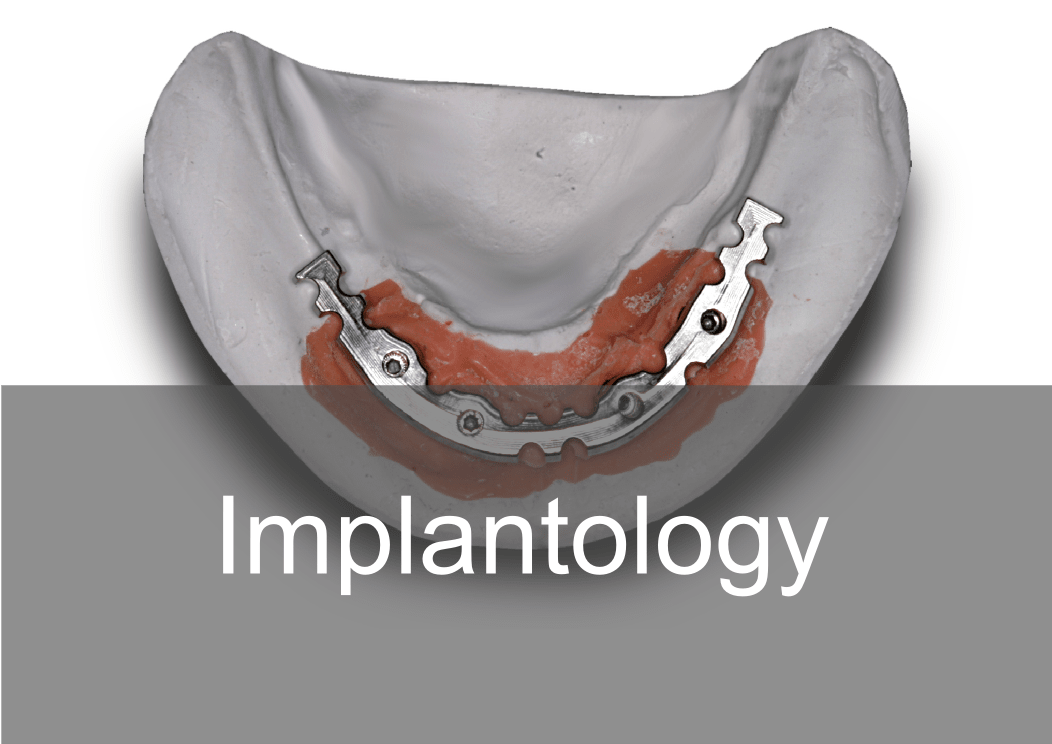 Implantology - BPL Dental Laboratory London 