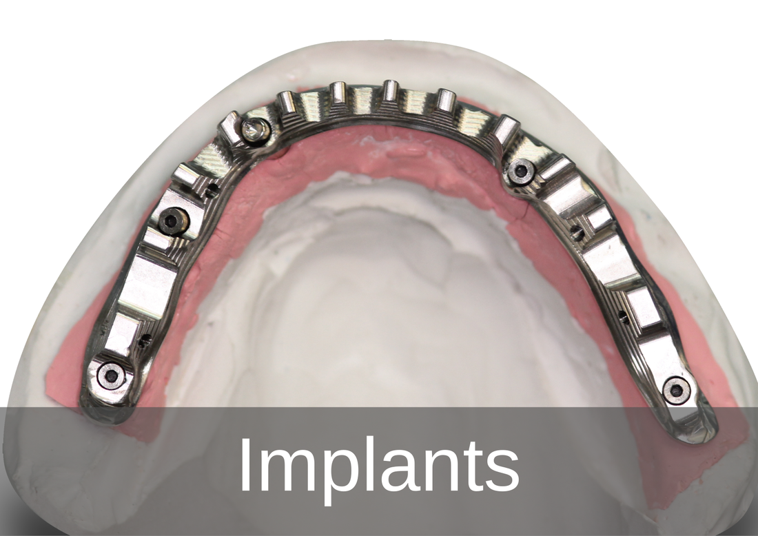 Implantology -  Bremadent Dental Laboratory, London