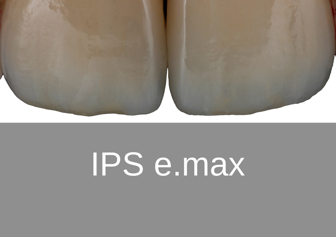 emax - Bremadent Dental Laboratory 