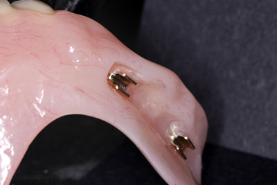 Swissedent removable implant denture on screw retained CM bar.