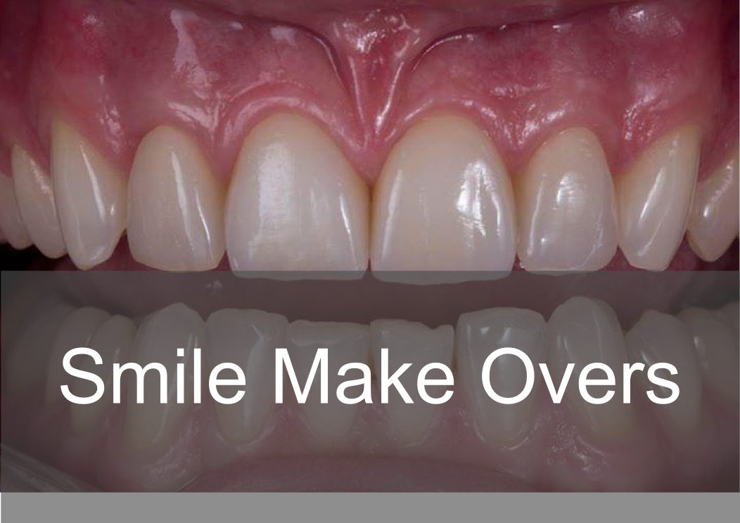 Smile Make Overs - Bremadent Dental Laboratory 